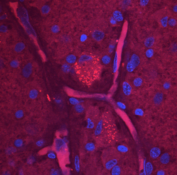 Amyloid Beta and Retinal Ganglion Cells