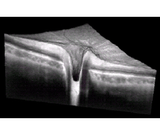 OCT Imaging of Human Retina
